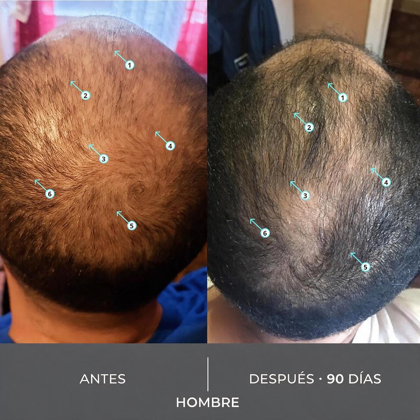 Revita® — Champú Densificador Extra Fuerte (con Nanoxidil 5%)