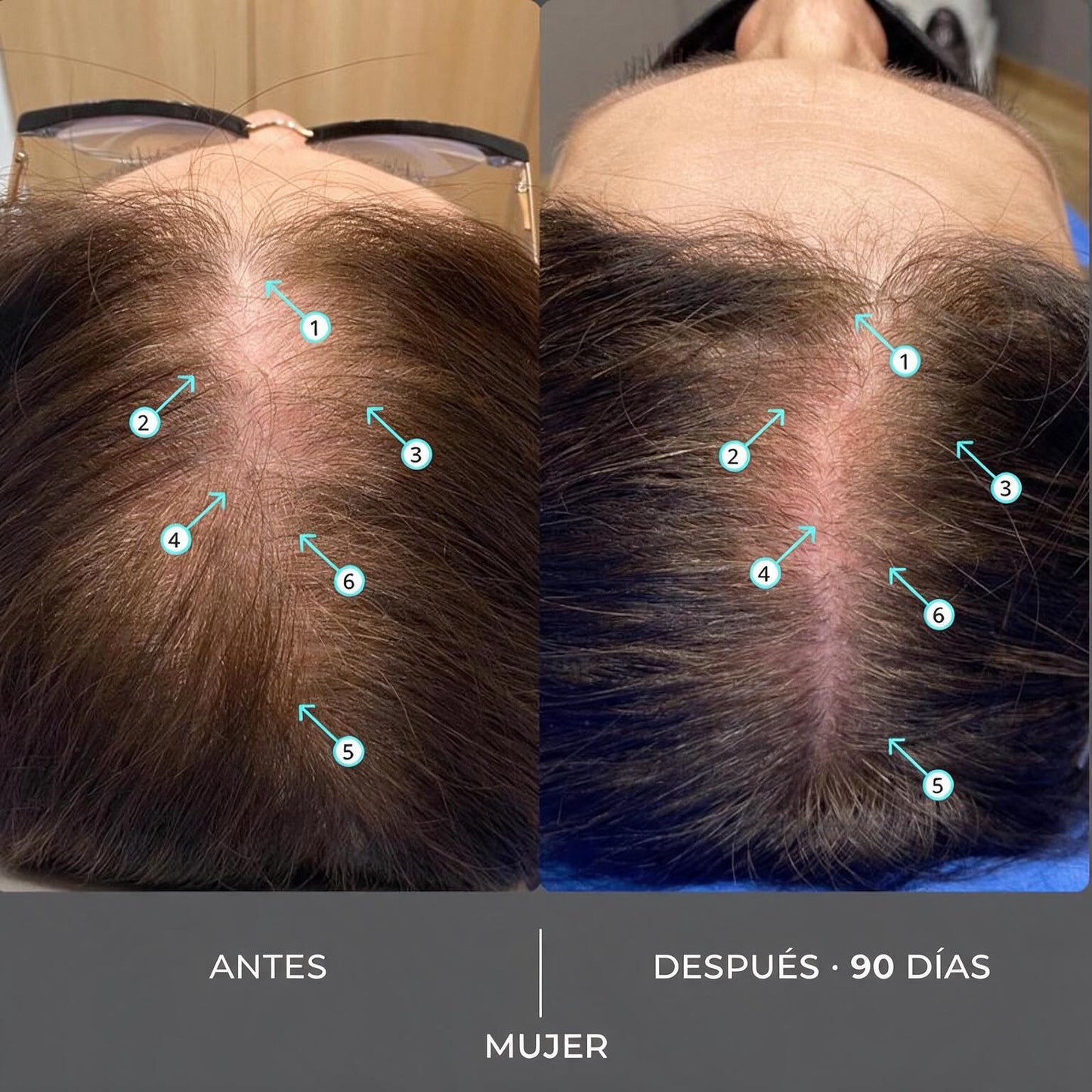 Revita® — Champú Densificador Extra Fuerte (con Nanoxidil 5%)